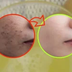Manchas oscuras en la piel de la cara, cómo deshacerse de ellas sin la ayuda del cirujano.